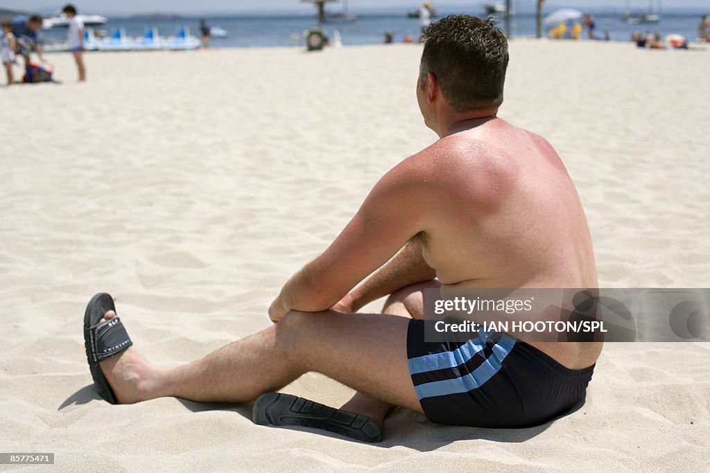 Man with sun burnt shoulders sitting on beach, rear view