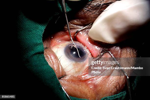 Surgeon performs cataract surgery on a patient at Cuba's and Venezuela's joint program 'Operacion Milagro,' Operation Miracle, at the Ramon Pando...