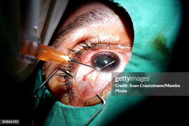 Surgeon performs cataract surgery on a patient at Cuba's and Venezuela's joint program 'Operacion Milagro,' Operation Miracle, at the Ramon Pando...