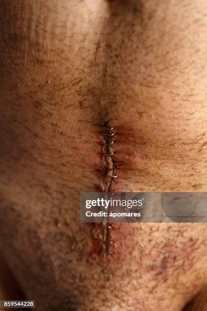 stitched up wound with staples in open surgery of radical prostatectomy - surgery stitches stock pictures, royalty-free photos & images