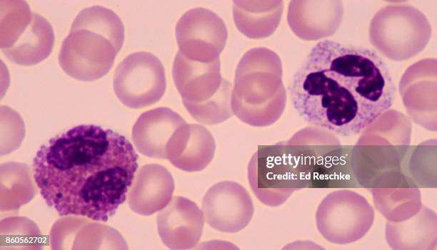 two white blood cells or leukocytes--neutrophil (right) and eosinophil (left), human blood smear, 500x - eosinófilo imagens e fotografias de stock