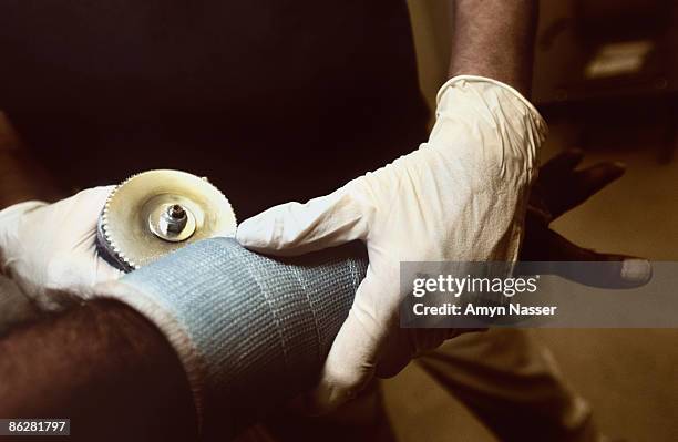 hands removing a cast from an arm - hand laceration stockfoto's en -beelden