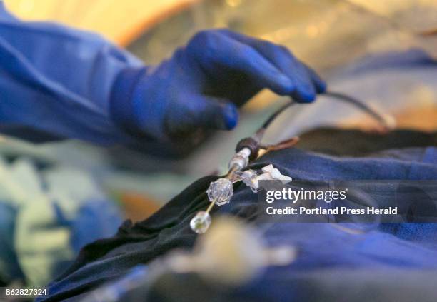 The deployment and placement of the Watchman device is controlled by a small knob at the end of a catheter, seen here during a procedure on patient...