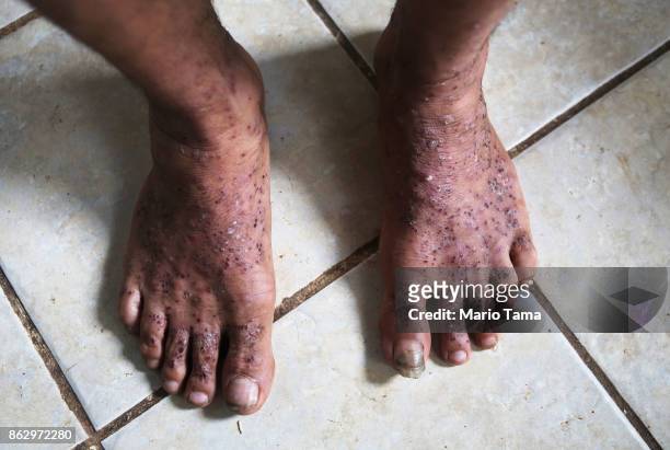 Juan Cordero stands displaying his injured feet, covered in ant bites, before being treated by an agent from the Special Response Team with U.S....