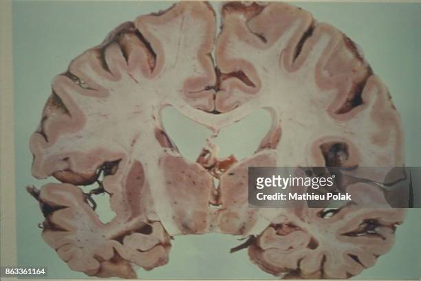 Laboratoire de recherches d'Edimbourg - Cerveau humain montrant des atteintes de la maladie de Creutzfeldt-Jacob.