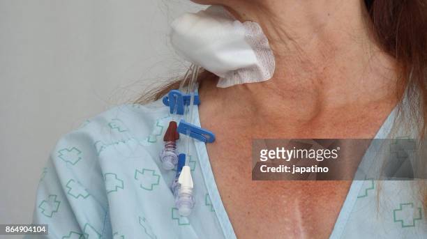 sick woman with a iv drip in her neck to give her medicines - streptomyces antibioticus imagens e fotografias de stock