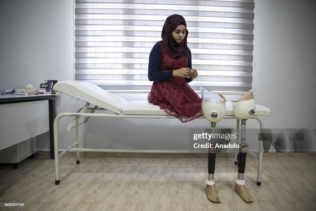 Syrian civil war took her legs