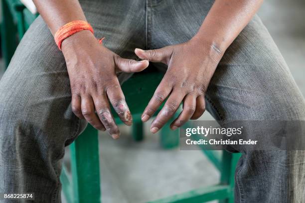 Bagdogra, India A man visiting a doctor because of his open wounds on his hands caused by the disease leprosy.