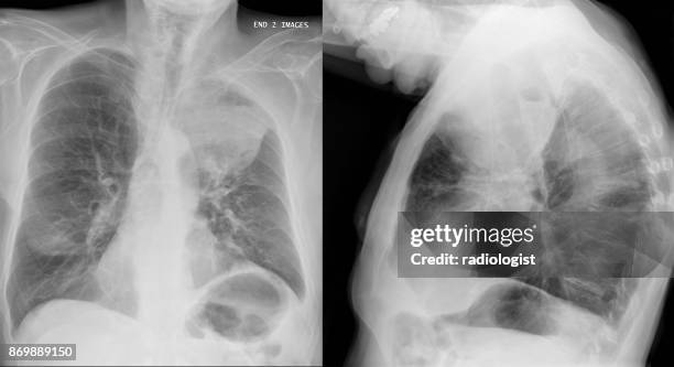 röntgen-thorax der ältere raucher mit lungenkrebs - emphysema stock-fotos und bilder