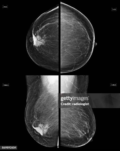 screening mammogram of breast cancer - cancer-screening stock pictures, royalty-free photos & images