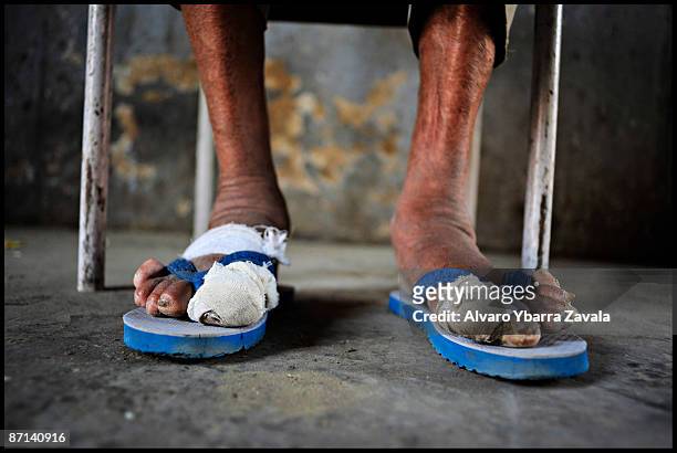 The feet of Babu Ram, who was turned out of his home when he became sick with leprosy, still show the painful affects of the disease. The voting for...