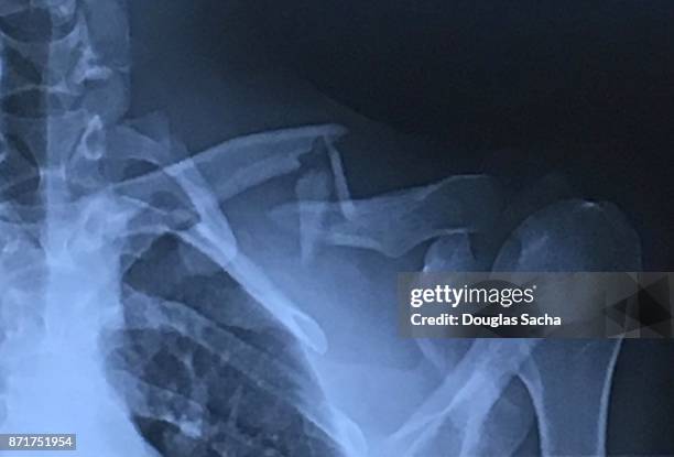 full frame of an x-ray image of a human shoulder with a broken clavicle or collarbone - équipement de radiologie photos et images de collection