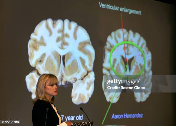 Dr. Ann McKee announces her findings on her examination of the brain of former New England Patriots player and convicted killer Aaron Hernandez...