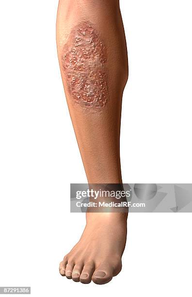 Pyoderma Gangrena Pyoderma Gangrenosum Illustration - Getty Images