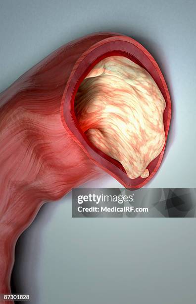 clogged aorta - clogged stock illustrations