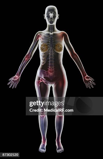 Spondylitis Spondylitis