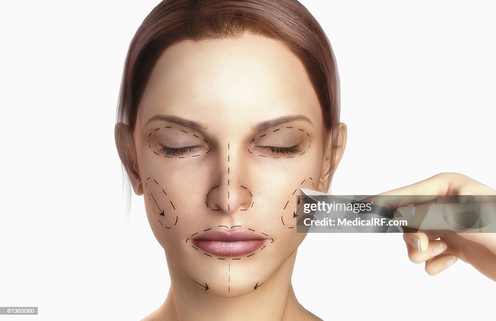 Rhytidectomy