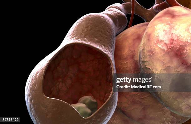 gallstones - gall stone stock illustrations
