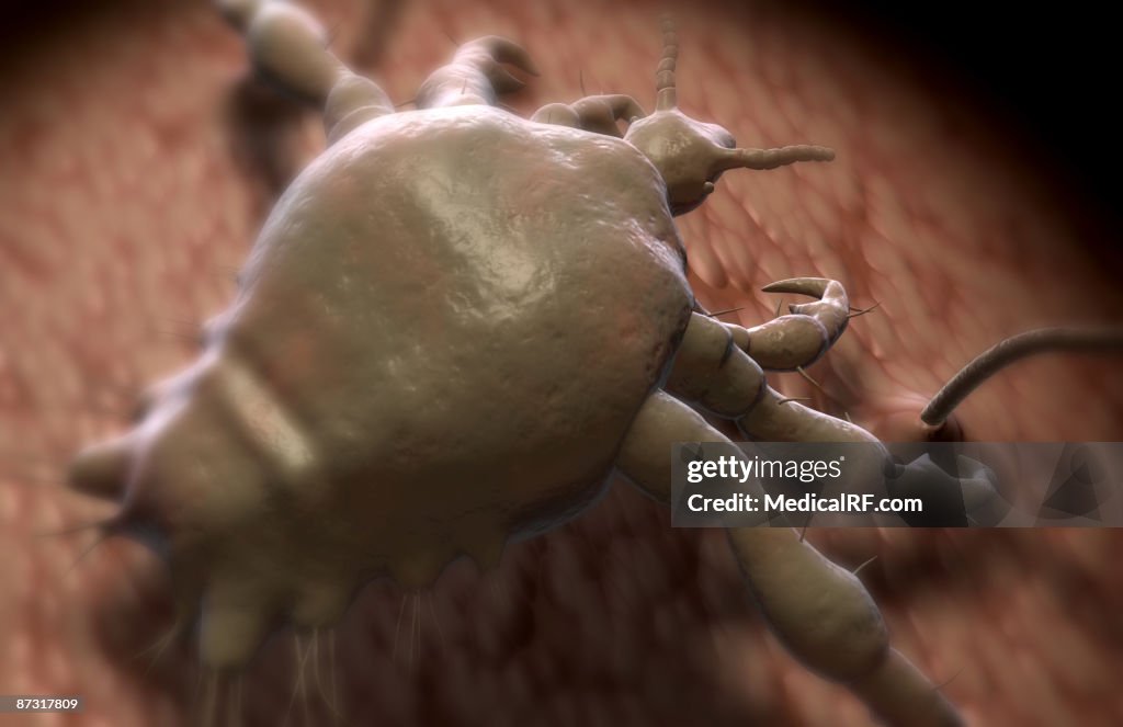 Pubic louse