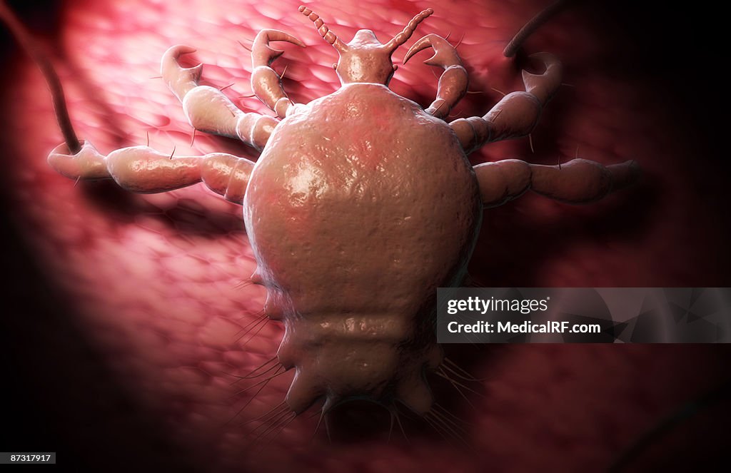 Pubic louse
