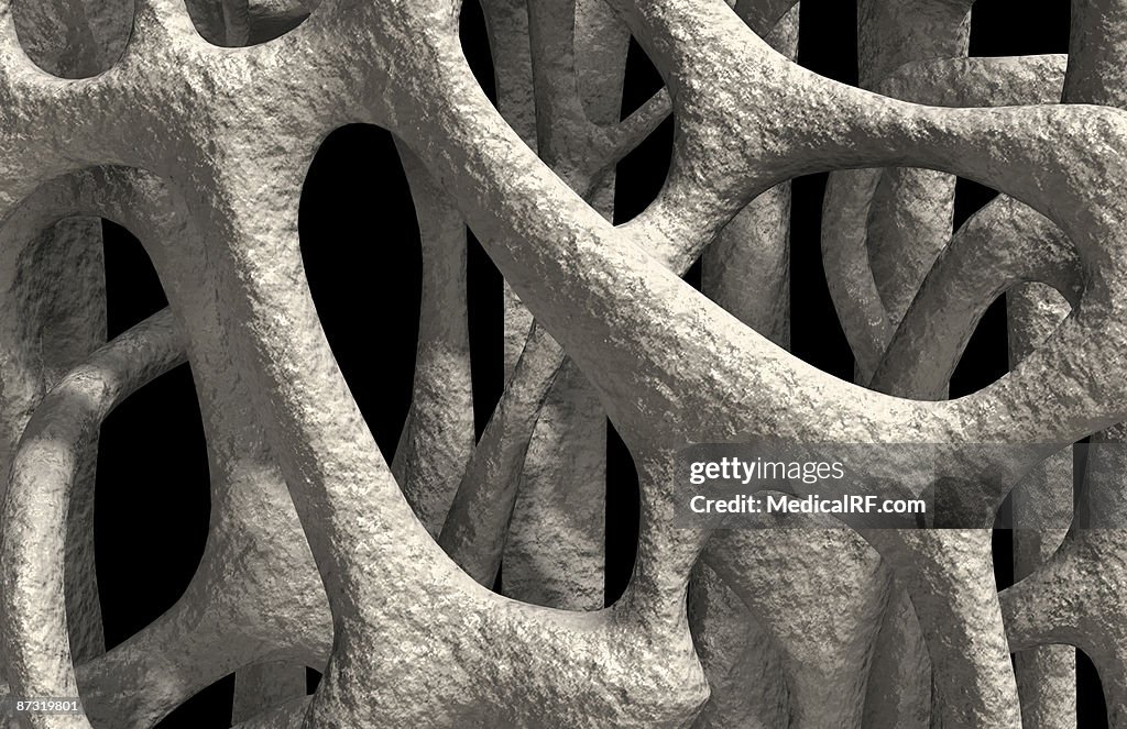 Osteoporosis