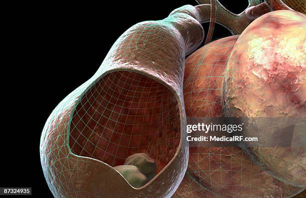 gallstones - gall stone stock illustrations