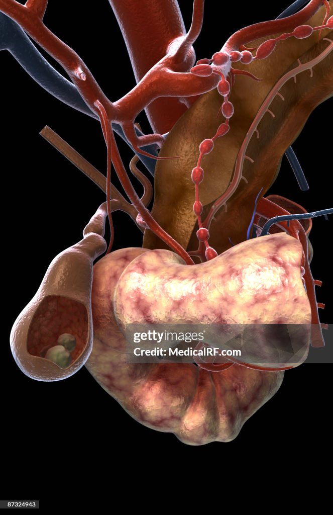 Gallstones