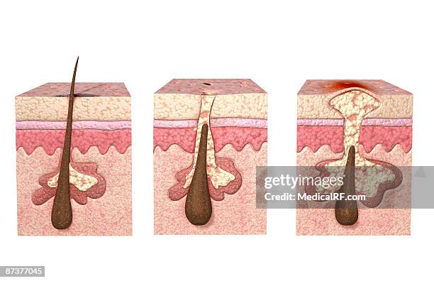 acne - sebaceous gland stock illustrations