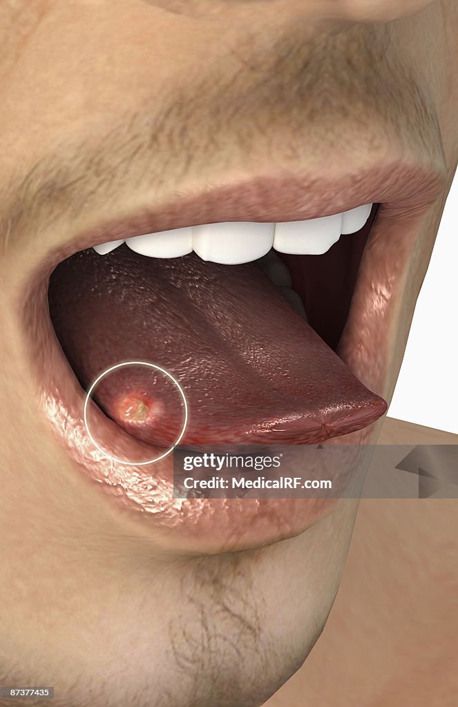 Mouth ulcer