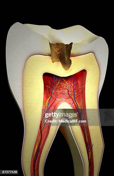 tooth decay - rotten com stock illustrations