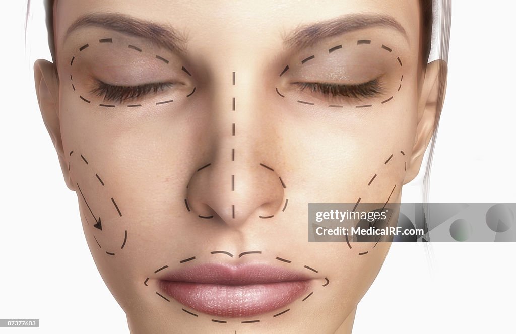 Rhytidectomy