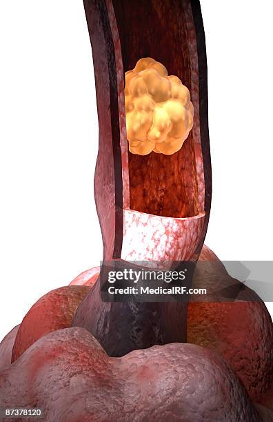 cystic fibrosis - mucus stock illustrations