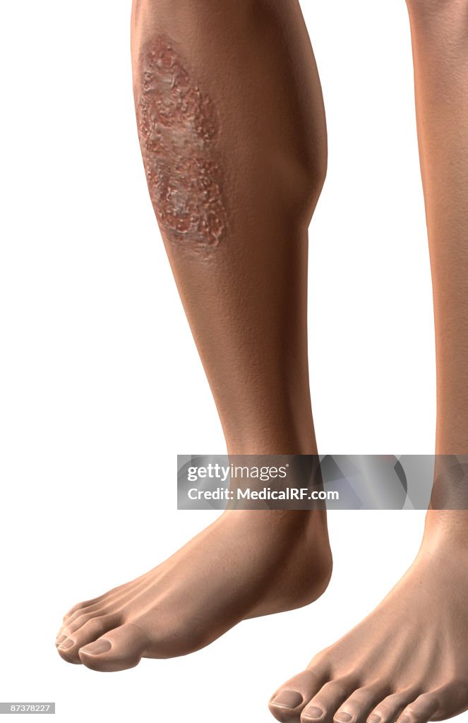 Pyoderma Gas Pyoderma Gangrenosum Illustration - Getty Images