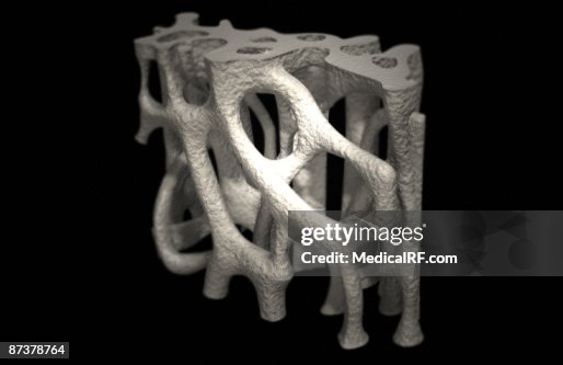 Osteoporosis bone structure Osteoporosis bone structure