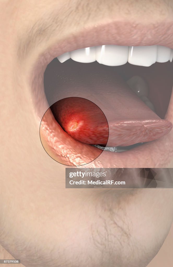 Mouth ulcer