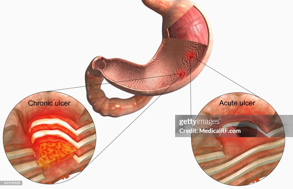 Stomach ulcer