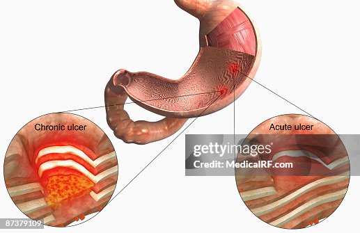 Ulzer Stomach Ulcer High-Res Vector Graphic - Getty Images