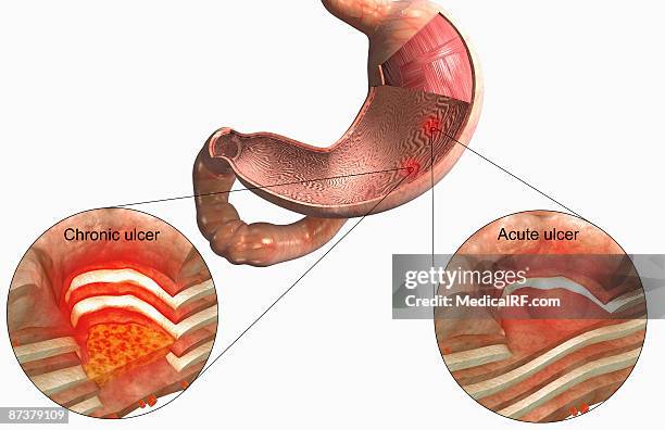 stomach ulcer - gastric ulcer 幅插畫檔、美工圖案、卡通及圖標