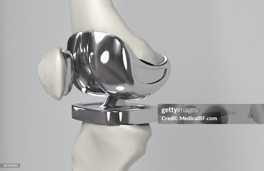 Knee replacement