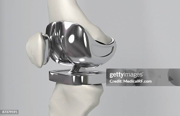 illustrazioni stock, clip art, cartoni animati e icone di tendenza di knee replacement - knee replacement surgery