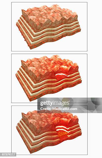 illustrations, cliparts, dessins animés et icônes de stomach ulcer - gastric ulcer