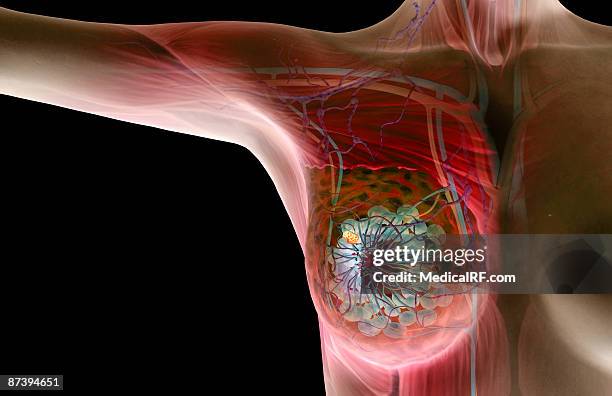 breast cancer - biomedical illustration stock illustrations