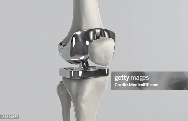 illustrazioni stock, clip art, cartoni animati e icone di tendenza di knee replacement - knee replacement surgery