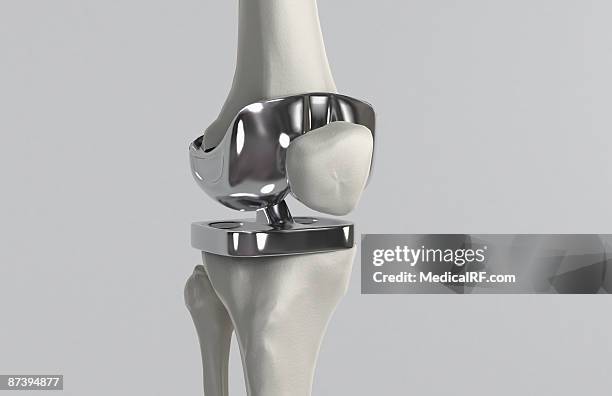 ilustrações, clipart, desenhos animados e ícones de knee replacement - knee replacement surgery