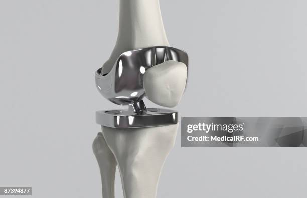 knee replacement - joint replacement stock illustrations