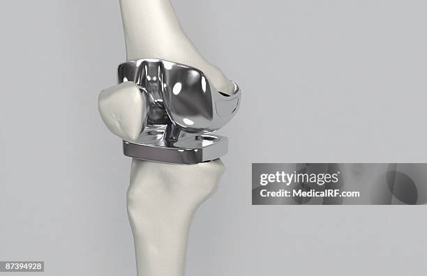 ilustrações, clipart, desenhos animados e ícones de knee replacement - knee replacement surgery
