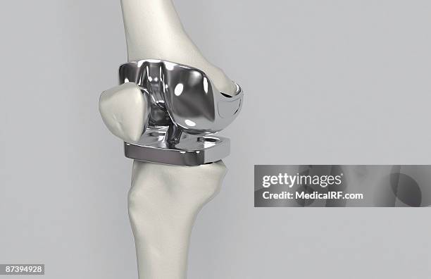 knee replacement - knee replacement surgery stock illustrations