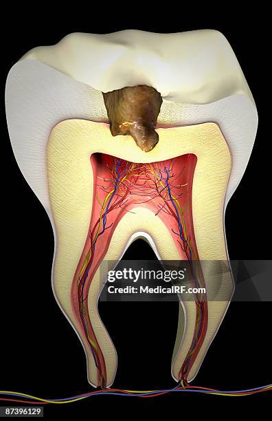 tooth decay - rotten com stock illustrations