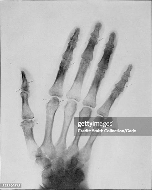 Early medical x ray image of a hand, showing arthritis, 1909. Courtesy Internet Archive.