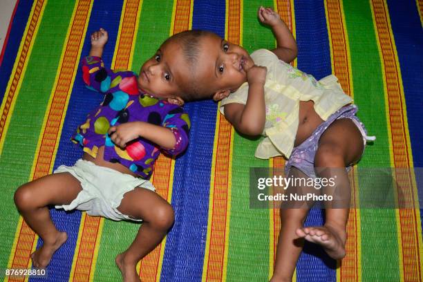 Conjoined twin girls Rabeya Islam and Rokeya Islam play at a Dhaka Medical Collage Hospital in Dhaka, Bangladesh on November 21, 2017. Taslima...